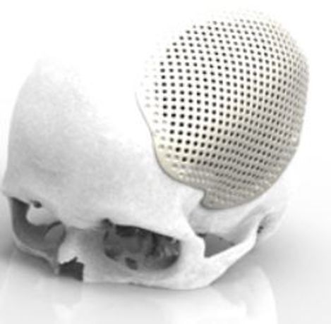 Renishaw - Craniomaxillofacial Implants and Software