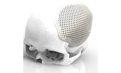 Renishaw - Craniomaxillofacial Implants and Software