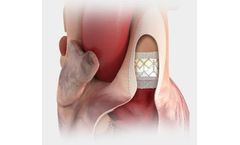 Edwards Sapien - Model XT - Transcatheter Heart Valves for Predictable Deployment