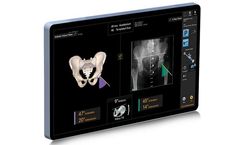 Smith-Nephew - Model RI.HIP - Real Intelligence Hip Navigation System