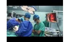 Endoscopic stapler used in surgery 1 - Video