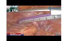 Qianjing endoscopic stapler used in surgery- Video