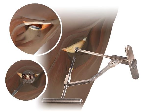 Anterior Path - Tissue Sparing Surgical Hip Approaches