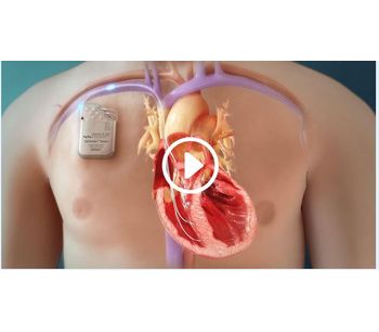 Optimizer - Cardiac Implantable Device
