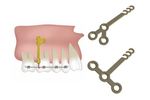 Jeil - Dual Top Anchor System - Orthodontic Anchor Plates