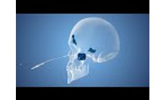 The Sinusleeve Balloon Sinus Dilation Sleeve Device by Dalent Medical - Video