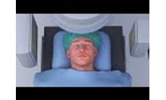 Neuro Thrombectomy Animation (USA) - Video
