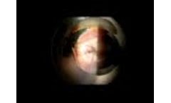 Ocular Wells Suture Manipulator Lens - Video