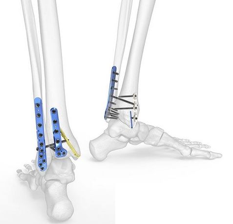 Acumed - Model 3 - Ankle Plating Fixation System