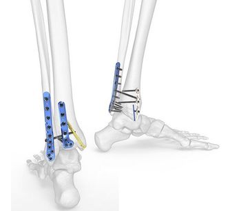 Acumed - Model 3 - Ankle Plating Fixation System