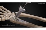 Osteomed ExtremiLOCK Wrist video