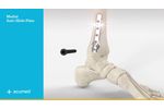 Acumed Ankle Plating System 3 - Video