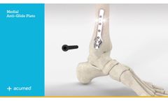 Acumed Ankle Plating System 3 - Video