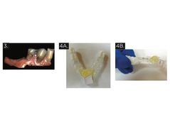 Dynamic Surgical Guidance to Facilitate Dental Implant Placement