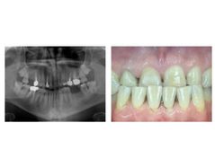 Predictable Precision Implant Placement Using Dynamic Surgical Guidance: a Five-month Follow-up - Case study