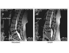 Postoperative Spinal Instability at L3-4 Revealed by Upright Weight-Bearing MRI - Case Study