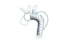 Castor - Branched Aortic Stent-Graft System