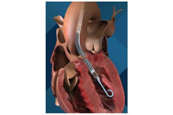 Impella - Model LD -5.0 - Minimally Invasive or Surgically Implanted Heart Pumps