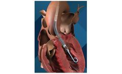 Impella - Model LD -5.0 - Minimally Invasive or Surgically Implanted Heart Pumps