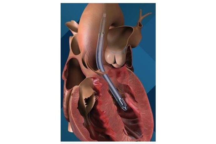 Impella - Model 5.5 - Minimally Invasive Heart Pump with Smart Assist