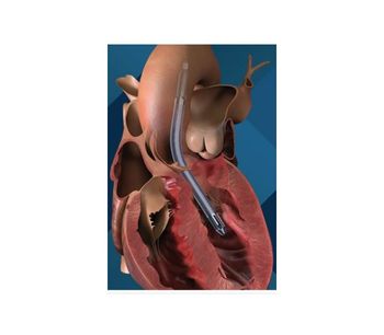 Impella - Model 5.5 - Minimally Invasive Heart Pump with Smart Assist