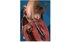 Impella 2.5 - Minimally Invasive Heart Pump