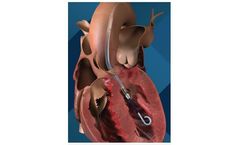 Impella CP - Minimally Invasive Temporary Heart Pump with SmartAssist