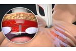 AtaCor Medical Intracostal Pacing System - Video