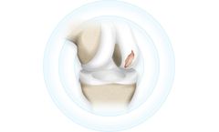 Hyalex - Restoring Human Cartilage