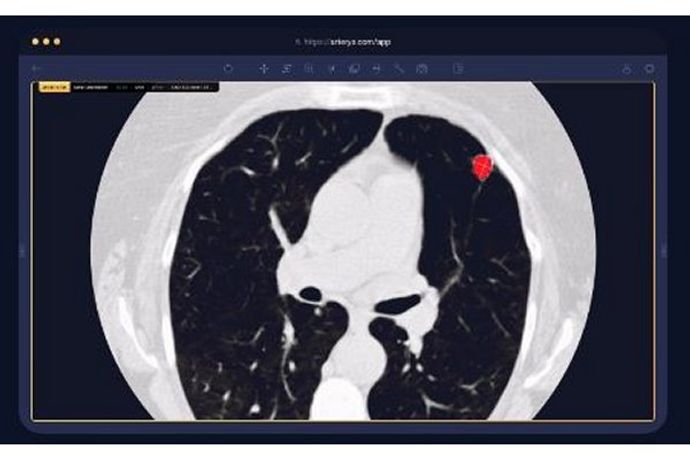Arterys - Version Lung AI - Assisted Chest CT Analysis Software