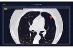 Arterys - Version Lung AI - Assisted Chest CT Analysis Software