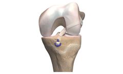OrthoPediatrics - Model ACL - Anterior Cruciate Ligament Reconstruction System