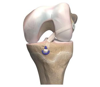 OrthoPediatrics - Model ACL - Anterior Cruciate Ligament Reconstruction System