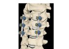 Model ALTOS PCT - Evolving the Gold Standard in Cervical Spinal Fusion Procedures