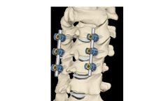 Model ALTOS PCT - Evolving the Gold Standard in Cervical Spinal Fusion Procedures