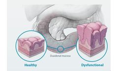 Duodenal Mucosal Resurfacing System (DMR) for Healthcare Professionals