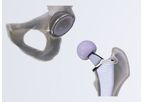 Cordera - Match Hip Replacement System