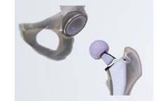 Cordera - Match Hip Replacement System
