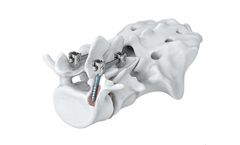 ATEC Arsenal - Cortical Bone Fixation System
