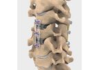 NuVasive - Model ACDF - Anterior Cervical Plate (ACP) System