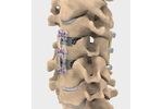 NuVasive - Model ACDF - Anterior Cervical Plate (ACP) System