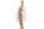 NuVasive - Adolescent Idiopathic Scoliosis (AIS)