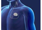 VNS Therapy - Vagus Nerve Stimulation Therapy for Difficult to Treat Depression