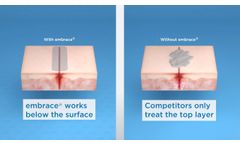 See How embrace® is Redefining Scar Therapy - Video