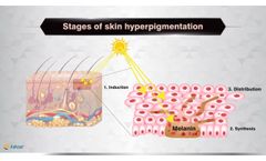 What is skin hyperpigmentation ? - Vdieo