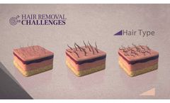 SHR 3D Technology - Soprano Laser Hair Removal - Video
