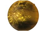 Sustained-Release Drug Delivery Platforms for Retinal Diseases - Medical / Health Care