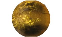 Sustained-Release Drug Delivery Platforms for Retinal Diseases