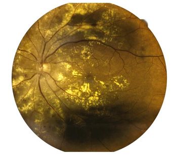 Sustained-Release Drug Delivery Platforms for Retinal Diseases - Medical / Health Care