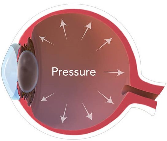 Solutions for Glaucoma and Intraocular Pressure (IOP) - Medical / Health Care